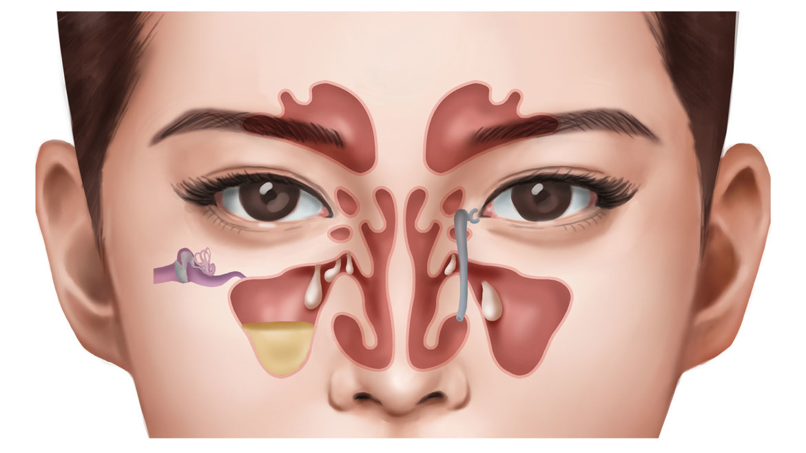 strankycinskemediciny-nosni-polypy