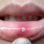 strankycinskemediciny-afty-v-ustech