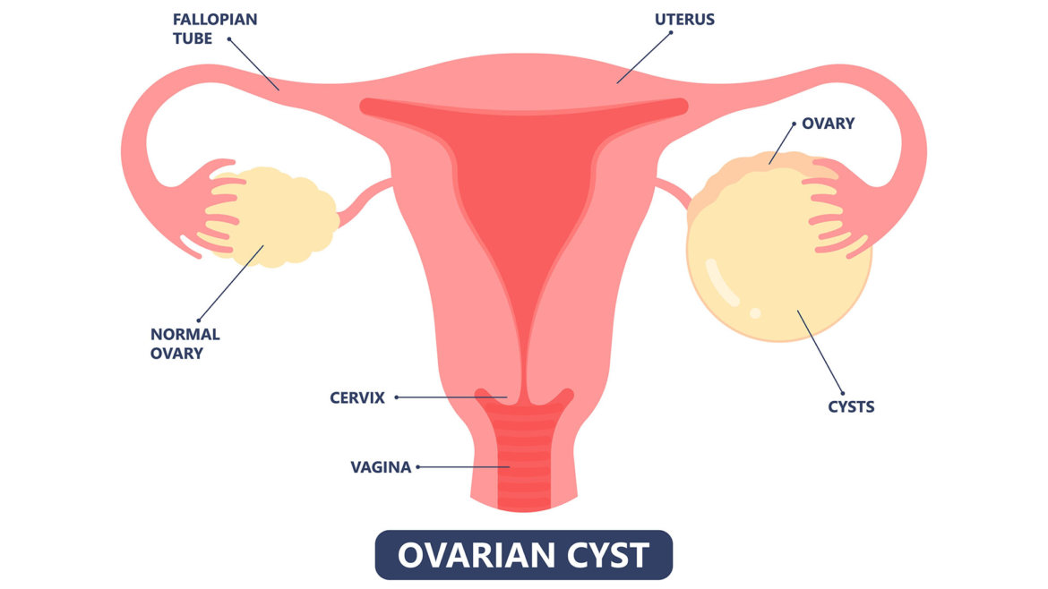strankycinskemediciny-cysty-vajecnikove-ovarialni