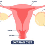Cysty vaječníkové - ovariální