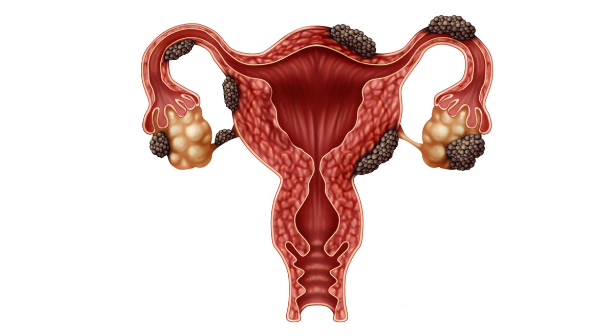 strankycinskemediciny-endometrioza