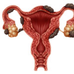 strankycinskemediciny-endometrioza