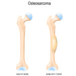 strankycinskemediciny-osteosarkom