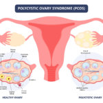 strankycinskemediciny-polycysticke-vajecniky