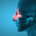 Sinusitida - zánět nosních dutin