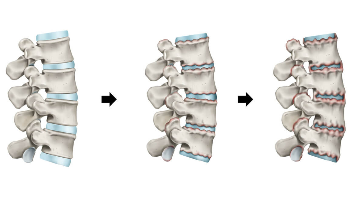 strankycinskemediciny-bechterevova-nemoc