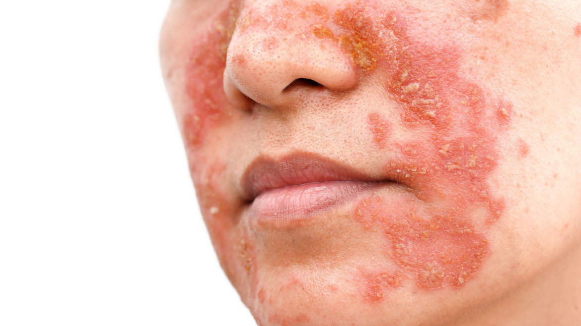 strankycinskemediciny-seboroicka-dermatitida-seborea