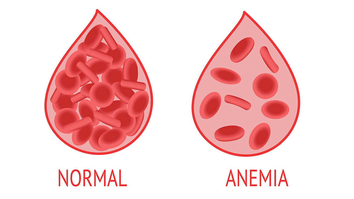 strankycinskemediciny-anemie