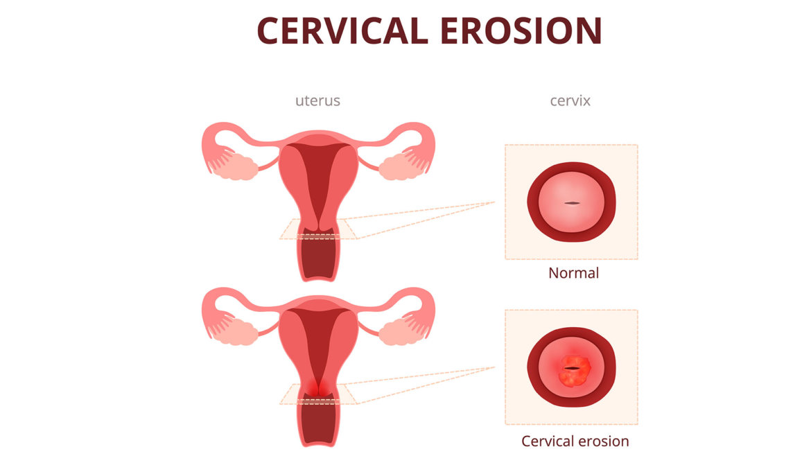 strankycinskemediciny-eroze-delozniho-cipku