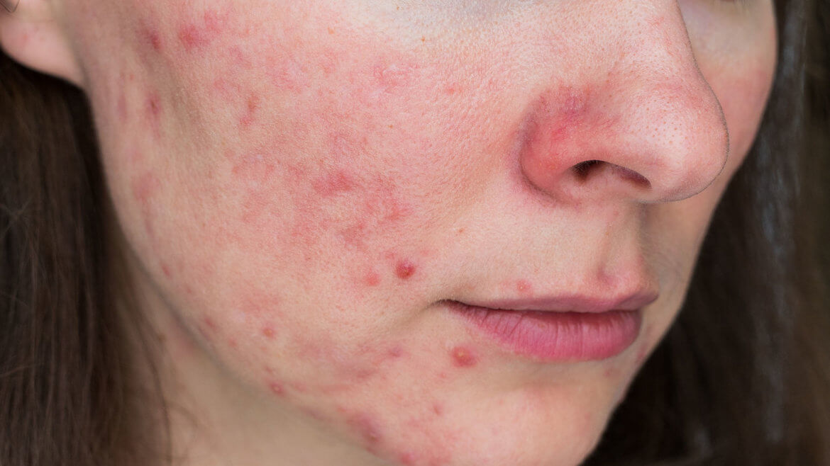 strankycinskemediciny-akne-rosacea-ruzovka