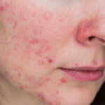 Růžovka - Rosacea strankycinskemediciny-akne-rosacea-ruzovka