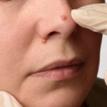 strankycinskemediciny-bradavice