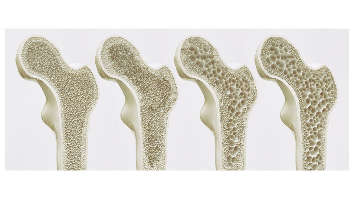 strankycinskemediciny-osteoporoza-ridnuti-kosti