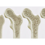 strankycinskemediciny-osteoporoza-ridnuti-kosti