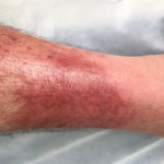 Růže - erysipel strankycinskemediciny-ruze-erysipel