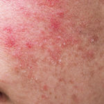 Dermatitida - zánět kůže
