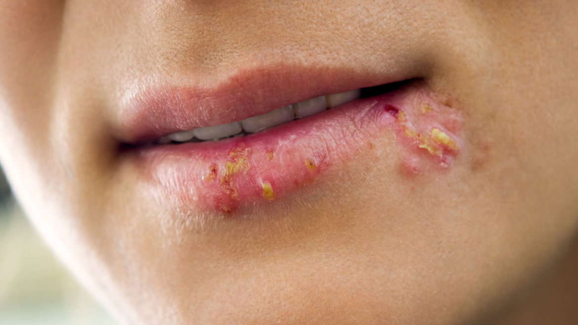 Opary – herpes strankycinskemediciny-opary-herpes