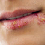 strankycinskemediciny-opary-herpes