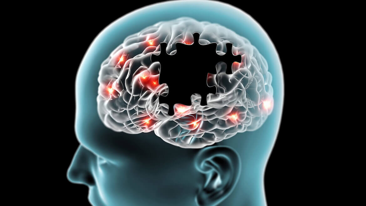 strankycinskemediciny-alzheimerova-choroba