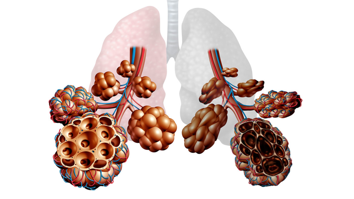 strankycinskemediciny-emfyzem-plicni-rozedma-plic