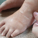 strankycinskemediciny-otoky