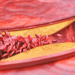 strankycinskemediciny-ateroskleroza-kornateni-tepen