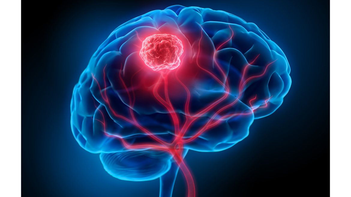 strankycinskemediciny-nador-rakovina-na-mozku