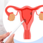 strankycinskemediciny-rakovina-karcinom-delohy-endometria