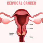 strankycinskemediciny-rakovina-karcinom-delozniho-cipku