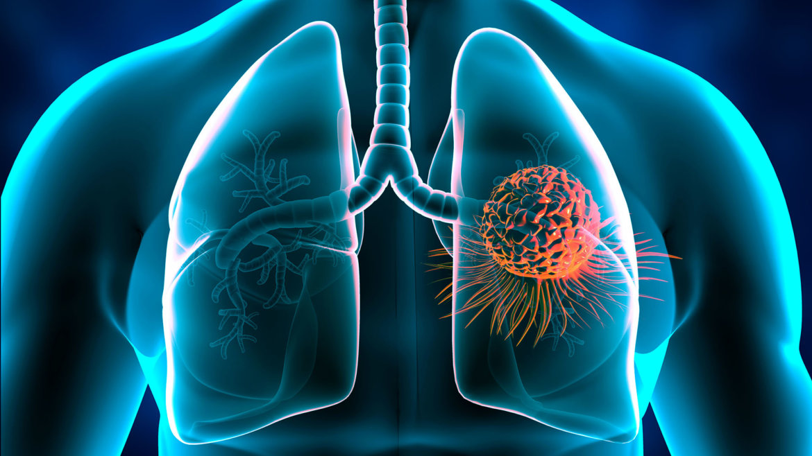strankycinskemediciny-rakovina-karcinom-plic
