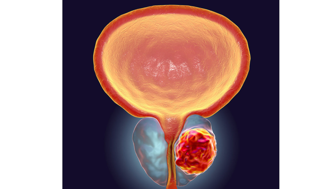 strankycinskemediciny-rakovina-karcinom-prostaty