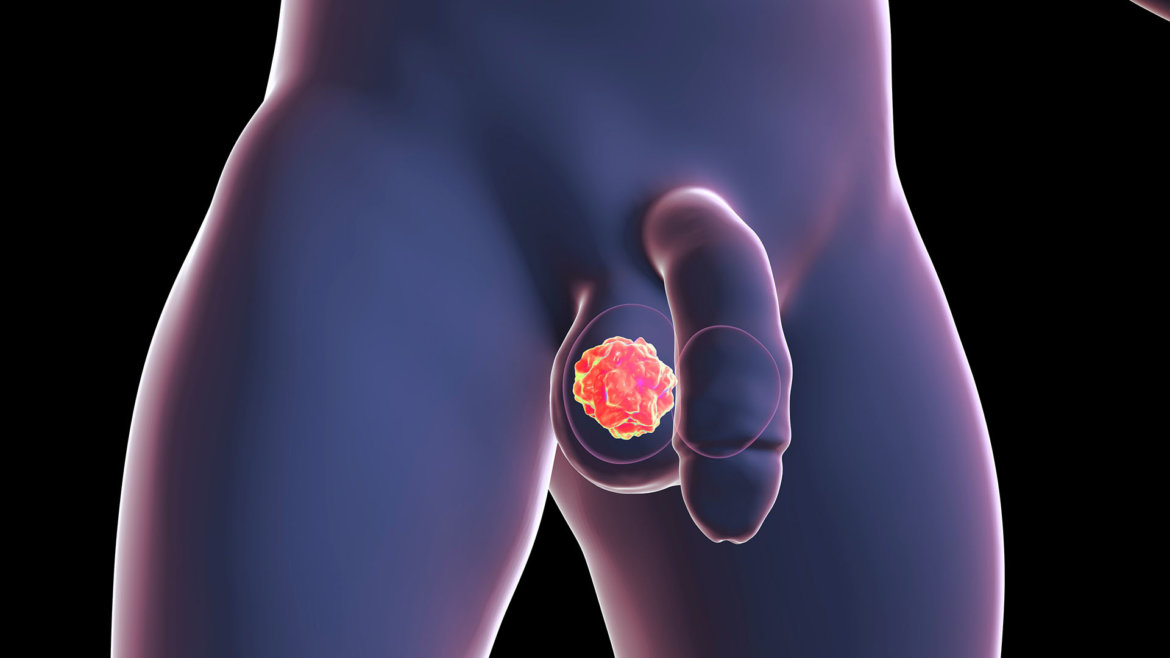 strankycinskemediciny-rakovina-karcinom-varlat