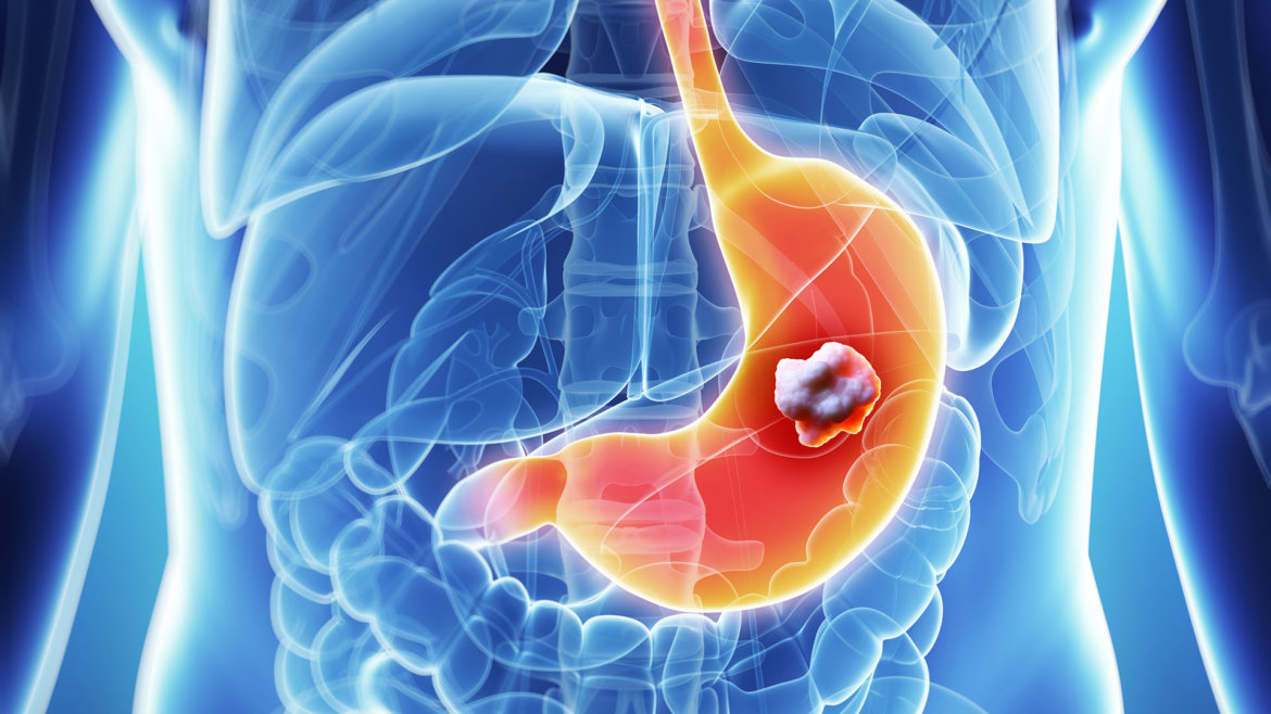 strankycinskemediciny-rakovina-karcinom-zaludku