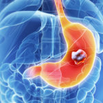 Rakovina - karcinom - žaludku