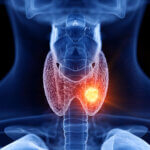 Ilustrace štítné žlázy s uzlíkem – uzlíky a cysty na štítné žláze, nezhoubné nádory, příznaky, diagnostika a léčba podle moderní medicíny i TCM.